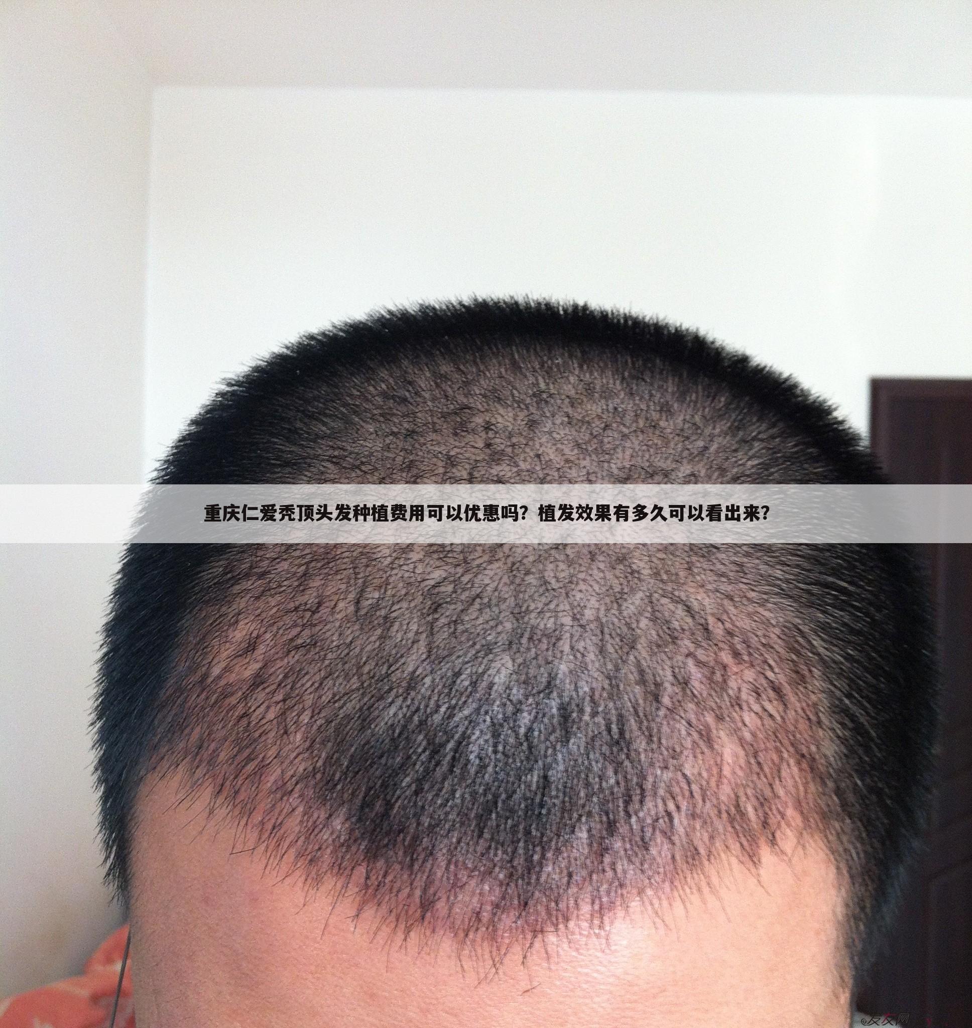 重庆仁爱秃顶头发种植费用可以优惠吗？植发效果有多久可以看出来？