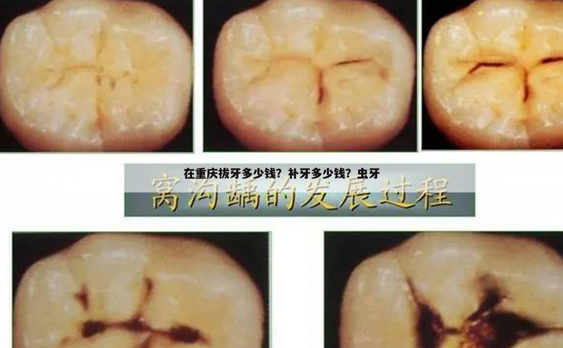 在重庆拔牙多少钱？补牙多少钱？虫牙