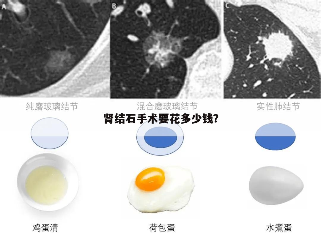 肾结石手术要花多少钱？