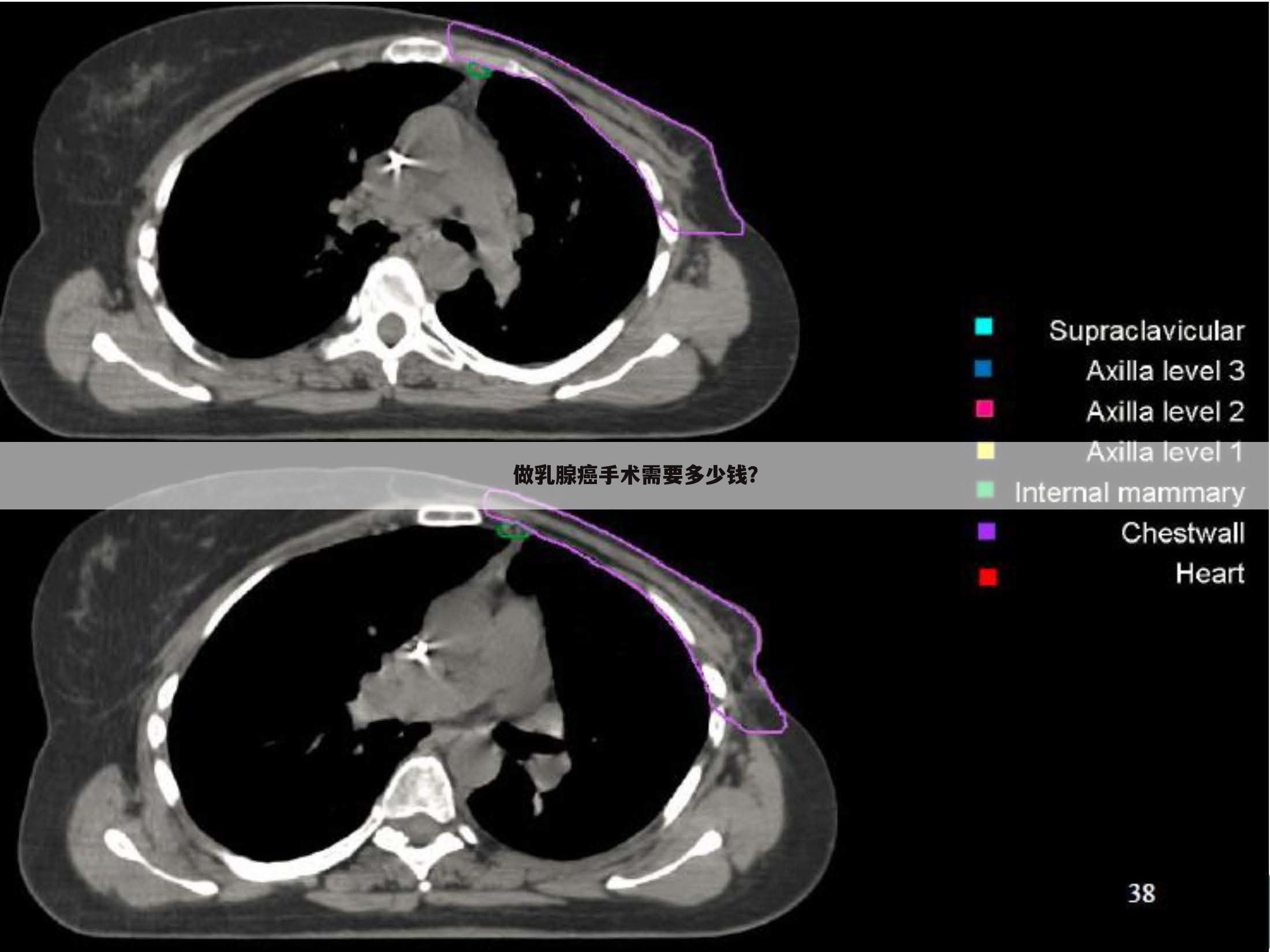 做乳腺癌手术需要多少钱？