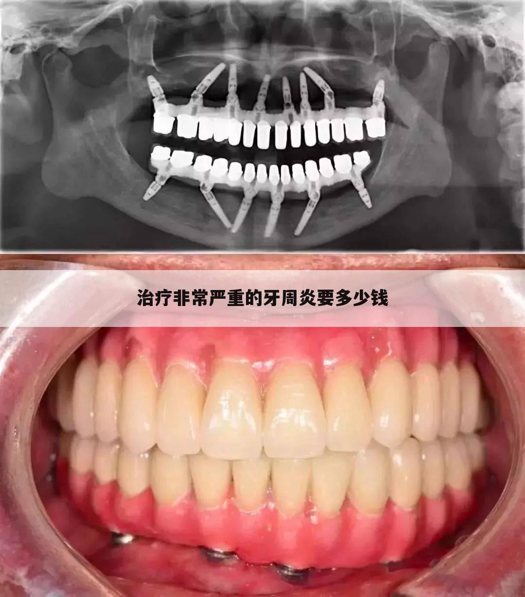 治疗非常严重的牙周炎要多少钱